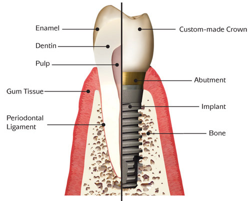 dental-implant-bone-graft-anatomy